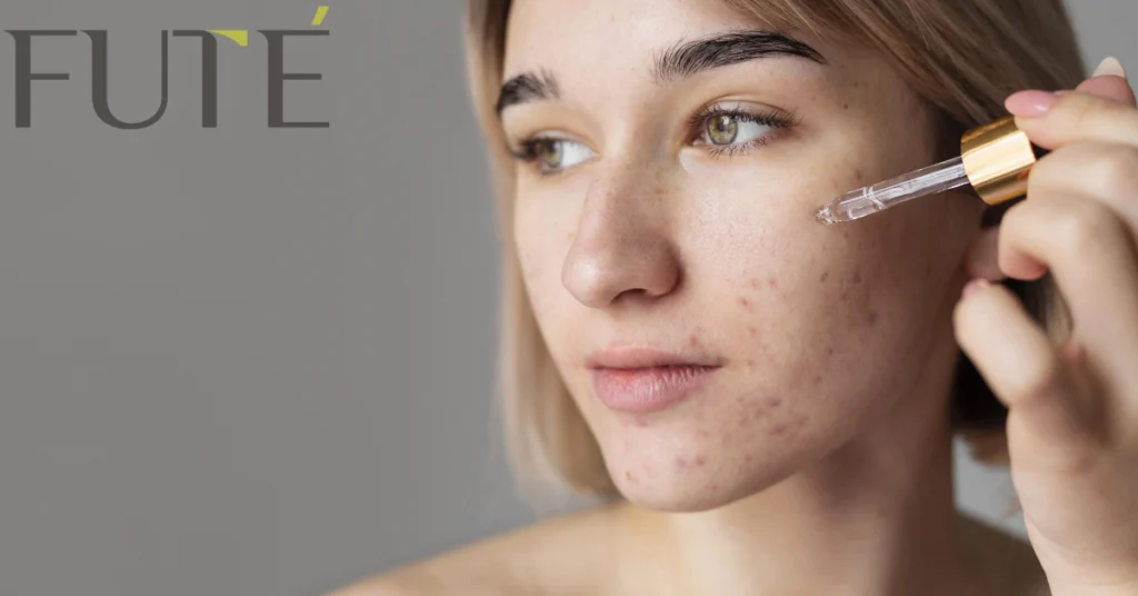 How Acne Clarifying Gel Clears Your Skin Fast